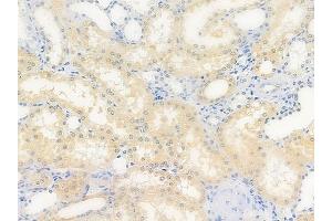ABIN6264994 and ABIN6279792 at 1/100 staining human renal cell carcinoma by IHC-P. (Septin 5 anticorps  (Internal Region))