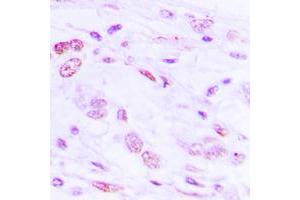 Immunohistochemical analysis of ATF2 (pS112) staining in human lung cancer formalin fixed paraffin embedded tissue section. (ATF2 anticorps  (pSer112))