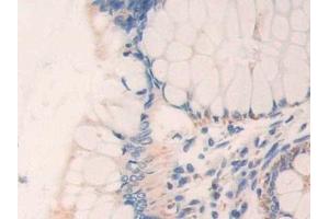 Detection of ETFb in Human Colorectal cancer Tissue using Polyclonal Antibody to Electron Transfer Flavoprotein Beta Polypeptide (ETFb)
