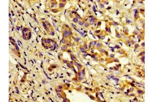 Immunohistochemistry of paraffin-embedded human liver cancer using ABIN7148357 at dilution of 1:100 (C1S anticorps  (AA 519-688))