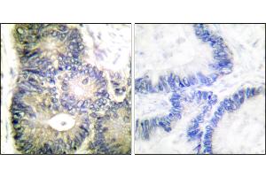 Immunohistochemical analysis of paraffin-embedded human colon carcinoma tissue using Cytochrome c antibody. (Cytochrome C anticorps)