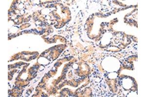 The image on the left is immunohistochemistry of paraffin-embedded Human thyroid cancer tissue using ABIN7191260(Lambda Light chain Antibody) at dilution 1/20, on the right is treated with synthetic peptide. (IGLV1-51 anticorps)