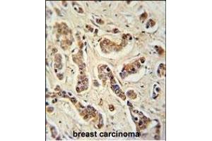 FA20A Antibody (N-term) (ABIN651160 and ABIN2840105) immunohistochemistry analysis in formalin fixed and paraffin embedded human breast carcinoma tissue followed by peroxidase conjugation of the secondary antibody and DAB staining.