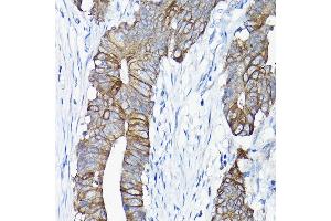 Immunohistochemistry of paraffin-embedded human colon carcinoma using  antibody (ABIN6127437, ABIN6136922, ABIN6136923 and ABIN6217829) at dilution of 1:50 (40x lens). (Annexin A13 anticorps  (AA 1-316))