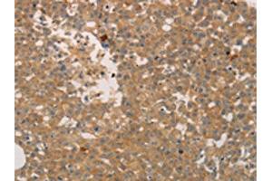 The image on the left is immunohistochemistry of paraffin-embedded Human breast cancer tissue using ABIN7189672(ADCYAP1R1 Antibody) at dilution 1/70, on the right is treated with synthetic peptide. (ADCYAP1R1 anticorps)
