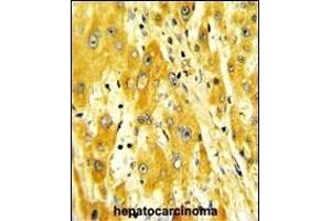 Formalin-fixed and paraffin-embedded human hepatocarcinoma with CD36 Antibody (Center), which was peroxidase-conjugated to the secondary antibody, followed by DAB staining.