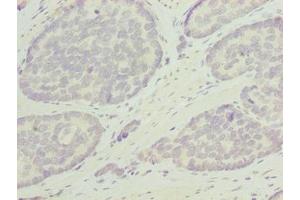 Immunohistochemistry of paraffin-embedded human gastric cancer using ABIN7162346 at dilution of 1:100 (ODF3L1 anticorps  (AA 1-274))