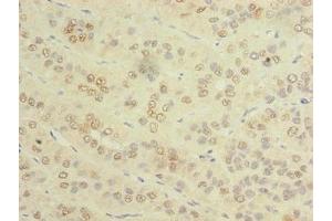Immunohistochemistry of paraffin-embedded human liver cancer using ABIN7173459 at dilution of 1:100 (TRIM51 anticorps  (AA 160-452))