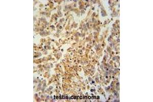 TEX9 antibody (N-term) immunohistochemistry analysis in formalin fixed and paraffin embedded human testis carcinoma followed by peroxidase conjugation of the secondary antibody and DAB staining. (TEX9 anticorps  (N-Term))
