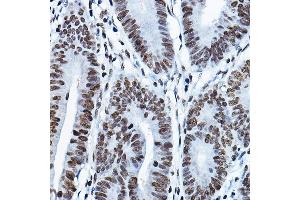Immunohistochemistry of paraffin-embedded human colon carcinoma using K Rabbit pAb (ABIN6128005, ABIN6142689, ABIN6142690 and ABIN6221516) at dilution of 1:100 (40x lens).