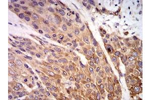 Immunohistochemical analysis of paraffin-embedded esophageal cancer tissues using P2RX7 mouse mAb with DAB staining.