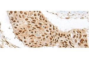 Immunohistochemistry of paraffin-embedded Human esophagus cancer tissue using ATE1 Polyclonal Antibody at dilution of 1:60(x200) (ATE1 anticorps)
