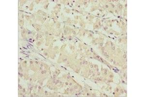 Immunohistochemistry of paraffin-embedded human gastric cancer using ABIN7171004 at dilution of 1:100 (SOCS4 anticorps  (AA 1-270))