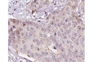 ABIN6266557 at 1/100 staining human liver carcinoma tissue sections by IHC-P. (HCG beta anticorps)