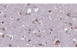 ABIN6276107 at 1/100 staining Human brain cancer tissue by IHC-P. (Mu Opioid Receptor 1 anticorps  (C-Term))