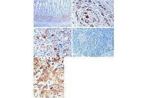 (TOP)Immunohistochemical analysis of EphB1 in gastric cancer tissues. (EPH Receptor B1 anticorps  (C-Term))