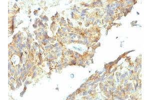 Formalin-fixed, paraffin-embedded human Ovarian Carcinoma stained with Alkaline Phosphatase Mouse Monoclonal Antibody (ALPL/597).