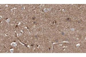 ABIN6279404 at 1/100 staining Human brain cancer tissue by IHC-P. (ZNRF1 anticorps  (Internal Region))