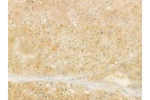 ABIN6259709 and ABIN6273189 at 1/100 staining human hepatocellular carcinoma by IHC-P. (ACAA1 anticorps  (N-Term))