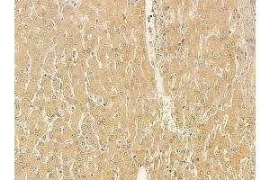 ABIN6261936 and ABIN6273247 at 1/100 staining human hepatocellular carcinoma by IHC-P. (ARHGEF25/GEFT anticorps  (Internal Region))