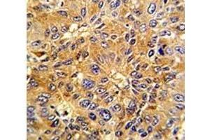 IHC analysis of FFPE human hepatocarcinoma with Cyclin A2 antibody (Cyclin A anticorps  (AA 51-84))