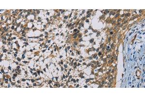 Immunohistochemistry of paraffin-embedded Human cervical cancer using CSNK1E Polyclonal Antibody at dilution of 1:60 (CK1 epsilon anticorps)