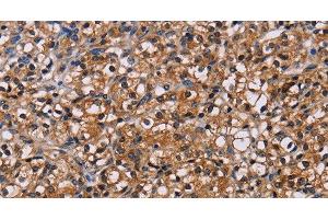 Immunohistochemistry of paraffin-embedded Human prostate cancer using NPM3 Polyclonal Antibody at dilution of 1:60 (NPM3 anticorps)