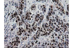 Immunohistochemical staining of paraffin-embedded Carcinoma of Human lung tissue using anti-HSPBP1 mouse monoclonal antibody. (HSPBP1 anticorps)