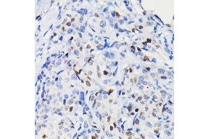 Immunohistochemistry of paraffin-embedded human breast cancer using [KO Validated] Cyclin D1 Rabbit mAb (ABIN7266561) at dilution of 1:100 (40x lens).