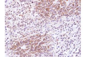 IHC-P Image Immunohistochemical analysis of paraffin-embedded SAS xenograft , using ATG4D, antibody at 1:100 dilution. (ATG4D anticorps  (Center))