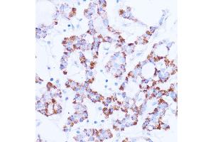Immunohistochemistry of paraffin-embedded human thyroid cancer using SIRT3 antibody  at dilution of 1:100 (40x lens). (SIRT3 anticorps  (C-Term))