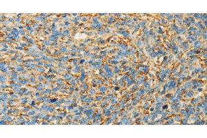 Immunohistochemistry of paraffin-embedded Human ovarian cancer tissue using APOA4 Polyclonal Antibody at dilution 1:30 (APOA4 anticorps)