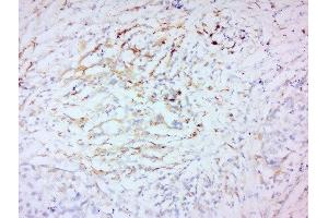 Formalin-fixed and paraffin embedded human laryngeal carcinoma labeled with Anti-MMP-2 Polyclonal Antibody, Unconjugated  at 1:200 followed by conjugation to the secondary antibody and DAB staining. (MMP2 anticorps  (AA 401-500))
