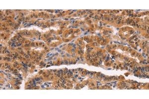 Immunohistochemistry of paraffin-embedded Human thyroid cancer tissue using NCAPG2 Polyclonal Antibody at dilution 1:50 (NCAPG2 anticorps)