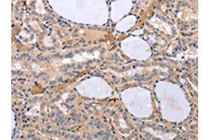 The image on the left is immunohistochemistry of paraffin-embedded Human thyroid cancer tissue using ABIN7192969(TYROBP Antibody) at dilution 1/30, on the right is treated with synthetic peptide. (TYROBP anticorps)
