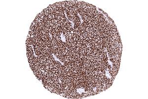 Synovial sarcoma with strong TLE1 positivity of all tumor cells (Recombinant TLE1 anticorps)