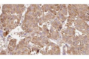 ABIN6268902 at 1/100 staining Human Melanoma tissue by IHC-P.
