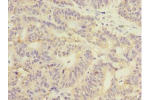 Immunohistochemistry of paraffin-embedded human colon cancer using ABIN7154098 at dilution of 1:100 (GSTK1 anticorps  (AA 1-226))