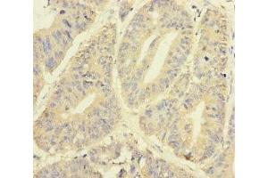 Immunohistochemistry of paraffin-embedded human colon cancer using ABIN7145012 at dilution of 1:100 (YME1L1 anticorps  (AA 1-240))