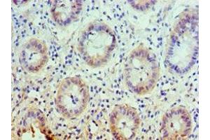 Immunohistochemistry of paraffin-embedded human colon cancer using ABIN7146355 at dilution of 1:100