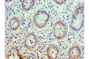Immunohistochemistry of paraffin-embedded human colon cancer using ABIN7146355 at dilution of 1:100 (slc25a13 anticorps  (AA 1-300))