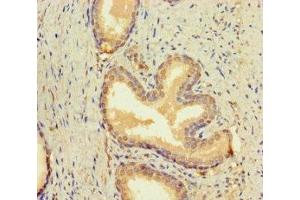 Immunohistochemistry of paraffin-embedded human prostate cancer using ABIN7145692 at dilution of 1:100 (BMP4 anticorps  (AA 303-408))