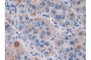 DAB staining on IHC-P; Samples: Human Liver cancer Tissue (CILP anticorps  (AA 603-846))