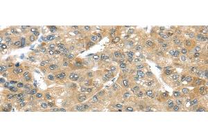 Immunohistochemistry of paraffin-embedded Human liver cancer tissue using TMPRSS4 Polyclonal Antibody at dilution 1:50 (TMPRSS4 anticorps)