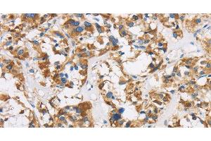 Immunohistochemistry of paraffin-embedded Human thyroid cancer using COX6B1 Polyclonal Antibody at dilution of 1:50 (COX6B1 anticorps)