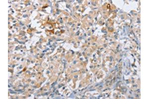 The image on the left is immunohistochemistry of paraffin-embedded Human thyroid cancer tissue using ABIN7190211(CENPE Antibody) at dilution 1/50, on the right is treated with synthetic peptide. (CENPE anticorps)