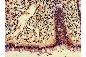 Immunohistochemistry of paraffin-embedded human colon cancer using ABIN7143368 at dilution of 1:100 (AJAP1 anticorps  (AA 308-394))