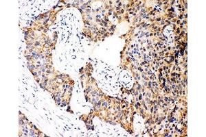 IHC-P: Caspase-12 antibody testing of human breast cancer tissue