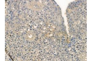 ABIN6257290 and ABIN6273658 at 1/100 staining human glioblastoma by IHC-P. (IL-25 anticorps  (Internal Region))