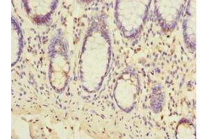 Immunohistochemistry of paraffin-embedded human colon cancer using ABIN7151978 at dilution of 1:100 (TMEM93 anticorps  (AA 2-47))